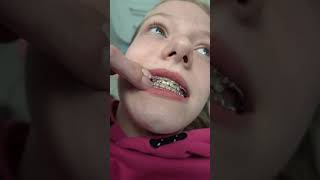 Moet ik GEOPEREERD worden door de KAAKCHIRURG Beugel controle bij de ORTHODONTIST shorts beugel [upl. by Eirac775]