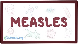 Measles  causes symptoms diagnosis treatment pathology [upl. by Nerok]