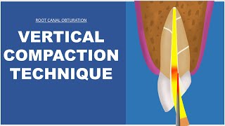 Vertical Compaction Technique  Root Canal Obturation [upl. by Lyudmila]