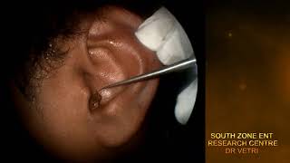 IMPACTED EAR WAX REMOVAL WITH HOOK HD [upl. by Amikahs525]