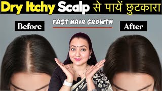 Dry Scalp Treatment At Home  Itchy Flaky Scalp से पाएं छुटकारा और पाएं Fast Hair Growth 💕 [upl. by Phenica]