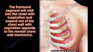 Flail Chest  Everything You Need To Know  Dr Nabil Ebraheim [upl. by Ezekiel]