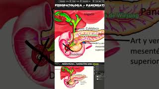 Pancreatitis Aguda por cálculos biliares doctor pancreatitis fisiopatologia [upl. by Sussi669]