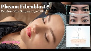 Plasma Fibroblast Non Surgical Blepharoplasty Eyelift Treatment amp Training Singapore [upl. by Silva]