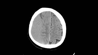 Hematoma subdural isodenso [upl. by Tija]