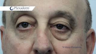 Mike Plexaderm Before amp After Head Turn [upl. by Fellner]