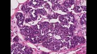 Histopathology Breast Lobular carcinoma in situ [upl. by Estrella]