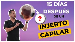 🟢👀Injerto Capilar 15 DÍAS DESPUÉS del Procedimiento 😮👈 [upl. by Latnahs]