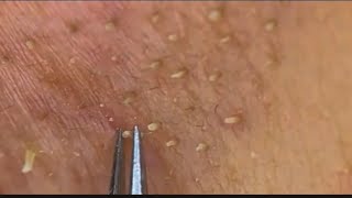 Plucking Blackheads whiteheads Satisfying and relaxing ASMR피지제거大量角栓 cabut komedo 去除皮脂角栓抜き [upl. by Behnken431]