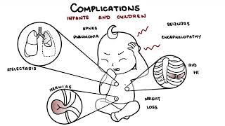 What is Pertussis and whooping cough  Bordetella pertussis symptoms pathophysiology and treatment [upl. by Briana934]