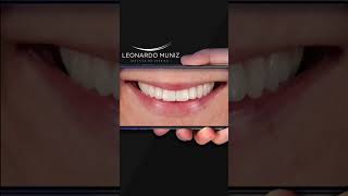 Transformaciones de sonrisas con resinas compuestas [upl. by Koehler]