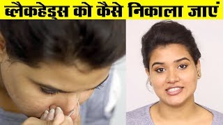 How to Remove Blackheads from Nose  Face Hindi [upl. by Ghiselin98]