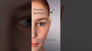 Bioosteoplastia de Fosa Temporal ¡Transformación facial instantánea [upl. by Hallerson]