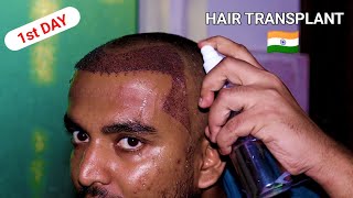 First Day After Hair Transplant in Delhi  Best Hair Transplant  From Hair Loss to Confidence [upl. by Mccoy]