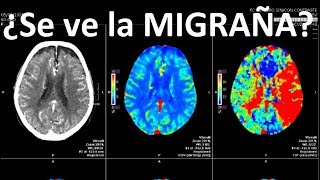 Se puede ver DOLOR de CABEZA o MIGRAÑA en resonancia o TAC [upl. by Laurella]