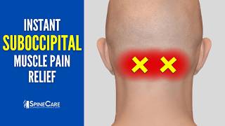 How to Fix Suboccipital Pain in 30 SECONDS Base of Skull Pain Relief [upl. by Glory]