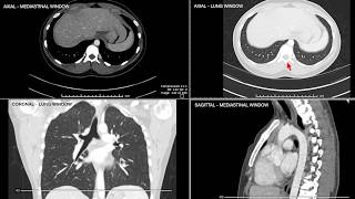 Introduction to Computed Tomographic imaging of the Chest [upl. by Adam161]