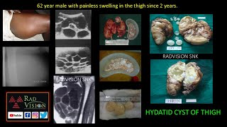 Hydatid cysts Imaging and complications [upl. by Nyliak]