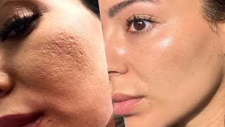 How I Got Rid of My Acne Scars and Large Open Pores [upl. by Esemaj310]