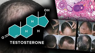 Testosterone Doesnt Grow Scalp Hair [upl. by Aynotan703]