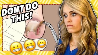 Doctor reacts Ingrown nail gone wrong [upl. by Panthea]