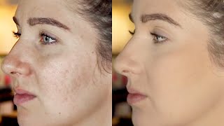 Pitted Acne Scar Makeup Tutorial Step by Step  Icepick ScarsBoxcar ScarsCraterspotmarks [upl. by Debby784]