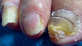 Onychomycosis infected the whole foot professional pedicure master【Pedicure Master Lin Jun】 [upl. by Lucien435]