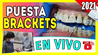 🔴 En Vivo Como se 𝗣𝗢𝗡𝗘𝗡 𝗟𝗢𝗦 𝗕𝗥𝗔𝗖𝗞𝗘𝗧𝗦 por PRIMERA VEZ  INSTALACIÓN de Brackets Paso A Paso 👌 [upl. by Briney]