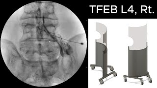 L4 Transforaminal Epidural Steroid Injection TFESI 정확하게 하는 방법 3 [upl. by Cosette653]