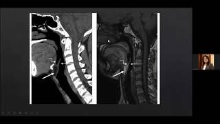 Radiological anatomy of Larynx and Hypopharynx Dr Kajari Bhattacharya [upl. by Gibrian]