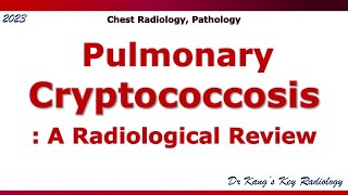 Pulmonary Cryptococcosis Radiologic Findings [upl. by Reste]