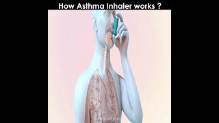 How asthma inhaler works [upl. by Assenej]