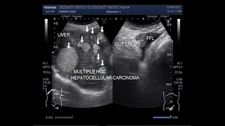 Multiple Hepatic Masses  HCC  mild Splenomegaly and minimum ascites [upl. by Siramed]