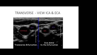 Carotid Doppler ultrasound [upl. by Auqinaj]