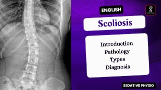 Scoliosis  Types Pathology Clinical Features  Orthopedic deformity  Sedative Physio [upl. by Mittel]