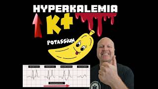 Why Hyperkalemia causes a widened QRS complex on the ECG  Explained [upl. by Mccartan262]