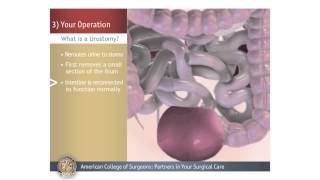 Urostomy Your Operation [upl. by Juline]