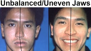 Orthodontic Treatment of Asymmetrical Unbalanced Disproportionate or Unequal Jaw by Dr Mike Mew [upl. by Neeloj]