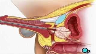 TURP Transurethral Resection Prostate penis Surgery  PreOp® Patient Education [upl. by Lazar569]