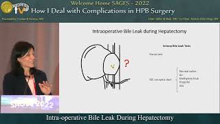 Intraoperative Bile Leak During Hepatectomy [upl. by Rammaj798]