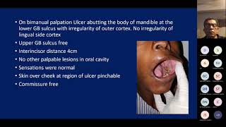 Plastiquest Case Discussion  Carcinoma Buccal Mucosa [upl. by Luthanen]