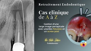 Retraitement endodontique Cas Clinique de A à Z fistule screw post obturation et controle [upl. by Conlen]