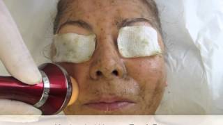 HUMEX Natural MTS Peel Procedure using CMS [upl. by Poppy]