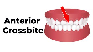 Easy Anterior Crossbite Correction for Pediatric Dentists in a Early Mixed Dentition Patient [upl. by Shugart421]