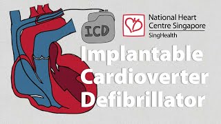 What is an Implantable CardioverterDefibrillator ICD  What to Expect [upl. by Landel]