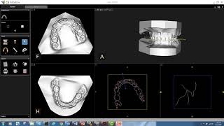 CS Model  Registration of Orthodontic Models CS 3600 [upl. by Eissak]