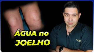 Descubra tudo sobre ÁGUA NO JOELHO  SINOVITE [upl. by Leasia]