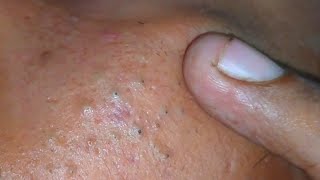 sac be spa blackheads elderly 2024  sac be spa old age blackheads acne  sac be spa face today 500 [upl. by Ardnuhsed]