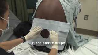 Adult Spinal Tap Procedure Video [upl. by Kennet]