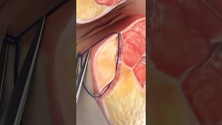 Laser Closure of Fistula Tract FiLaC Video credit SurgMedia Youtubecom [upl. by Agem]